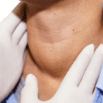 Pescoço de paciente com inchaço visível sendo examinado por médico, indicando possível hipertireoidismo